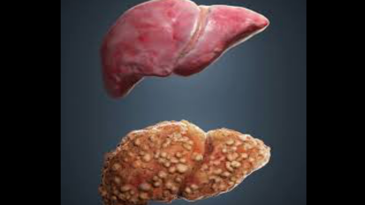 Liver cirrhosis in marathi