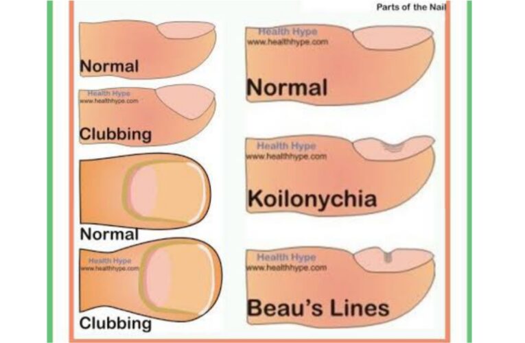 Nails and disease relationship in marathi