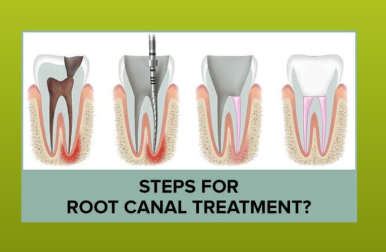 Root canal in marathi