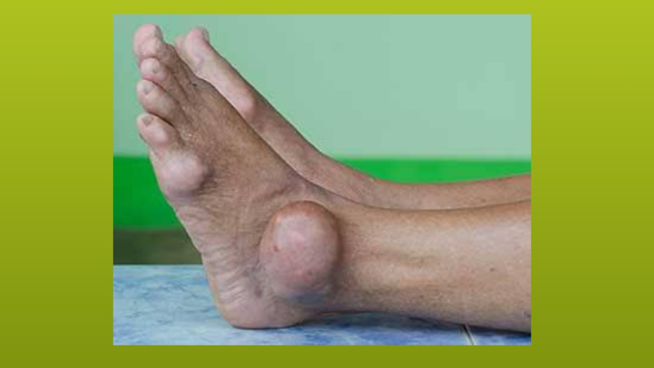 Gout in marathi