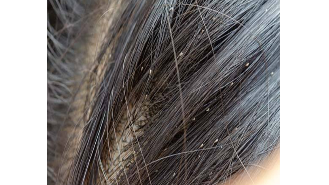 Head lice treatment in marathi